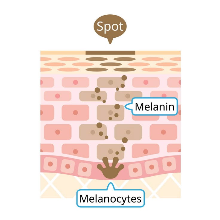 Your dark spots have two causes. Every other cream only targets one. 